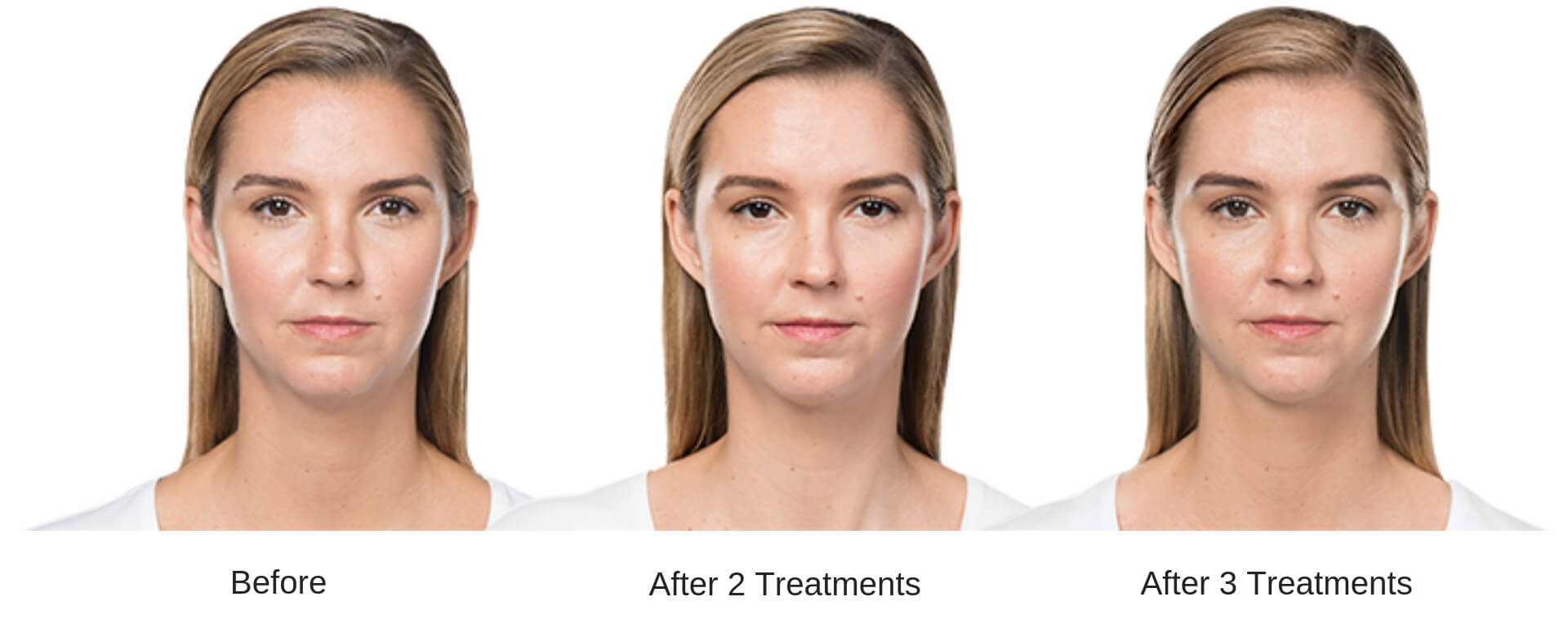 Kybella Treatment | FDA Approved | Goodbye Double Chin